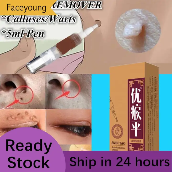 mole and skin tag remover