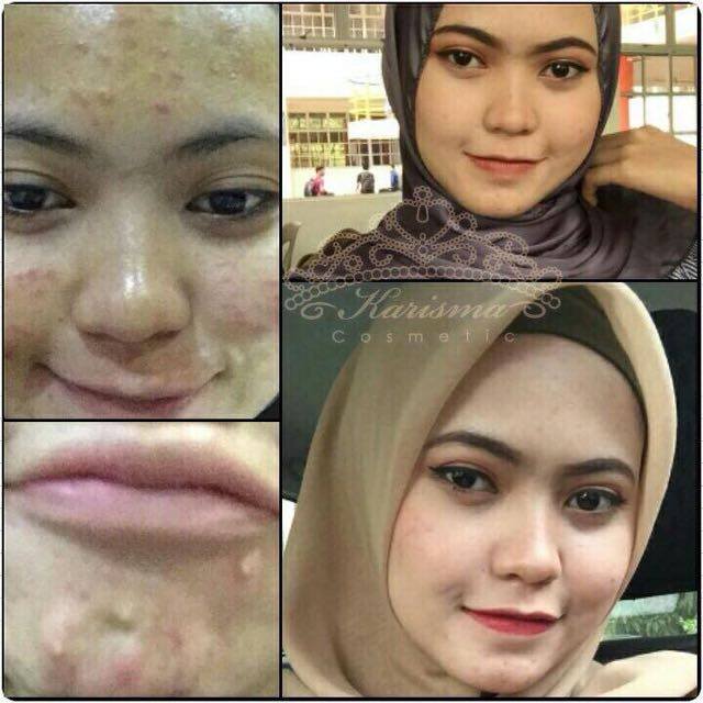 testimoni karisma skincare