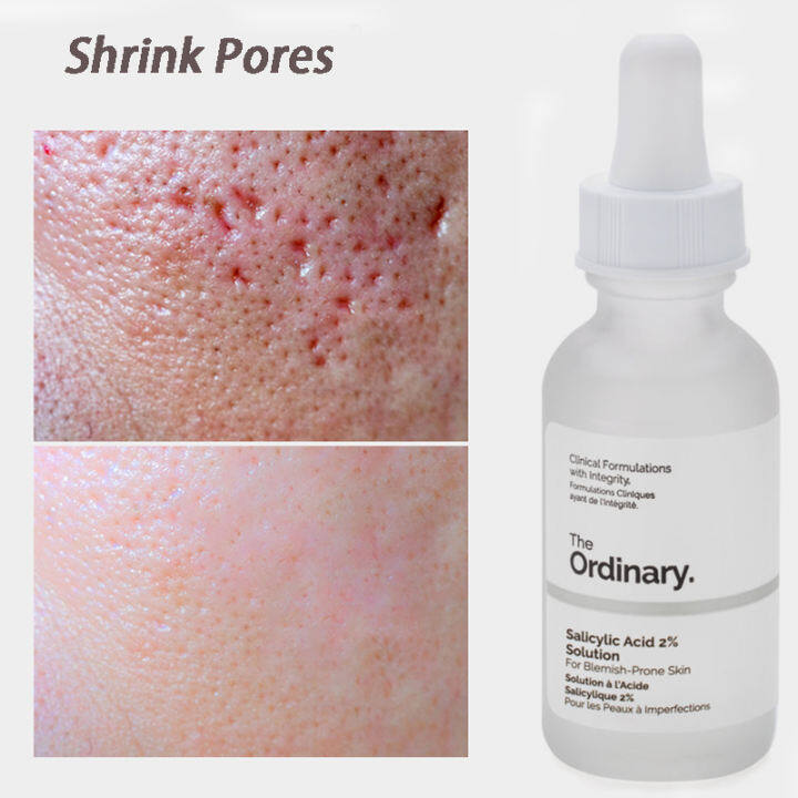 the ordinary blackhead serum