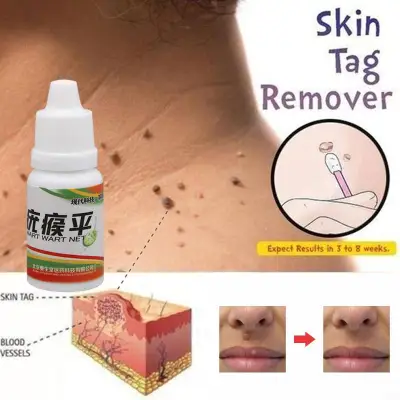 10ml Mole & Skin Tag Removal Solution 100% Remover Skin Tags & Warts & Moles Skin Tag Remover 12 Hours Remover Skin Tag Mole Foot Corn Blackhead Remover