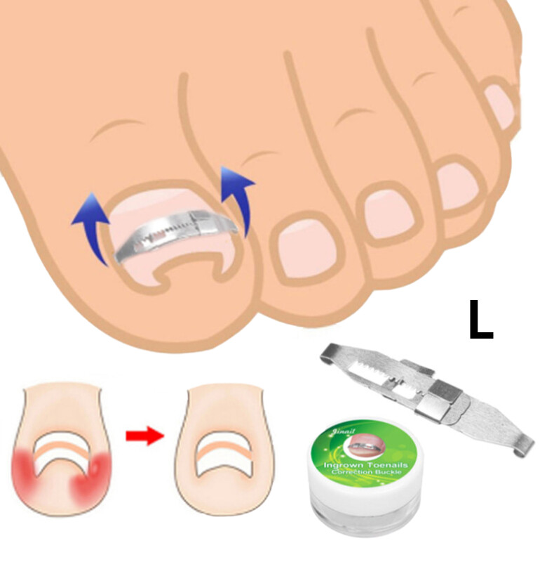 【High Quality+ In Stock】Ingrown Toe Nail Correction Tool Toenail Straightening Correctors Patch ToolKit