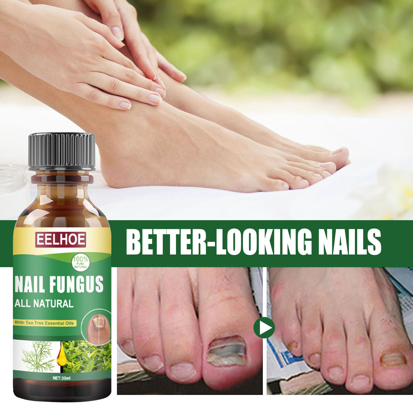 Eelhoe Tea Tree Oil Nail Fungus Treatment Essence Anti Infective Paronychia  Onychomycosis Toe Care Repair Serum Foot Nail Fungus Repair Gel Foot Care  Solution（30ml） | Lazada PH