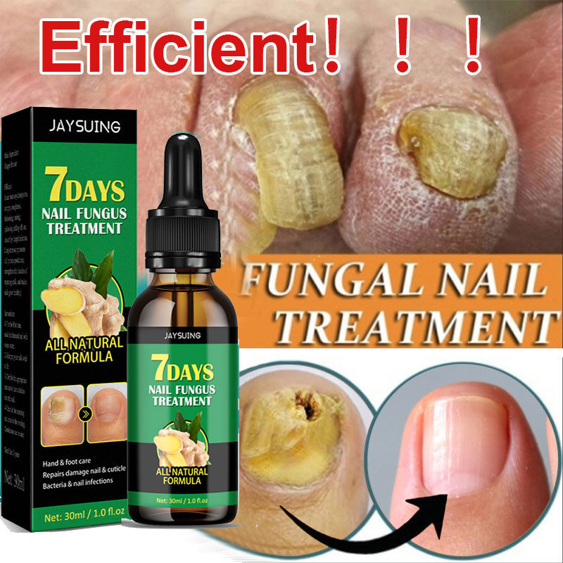 Jaysuing 30ml Ginger Nail Fungus Treatments Serum Spray Repair Toe Nail ...