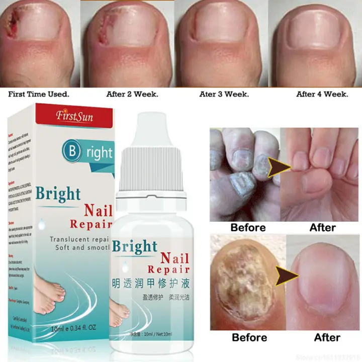 10ml Nail Fungus Treatment Cream Onychomycosis Paronychia Anti Fungal Nail Infection Kills 99 9 Bacteria And Fungus Lazada Singapore