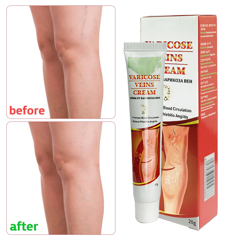 1 pcs Genital Scrotum Varicocele Remover Treatment Varicose Veins Cream ...