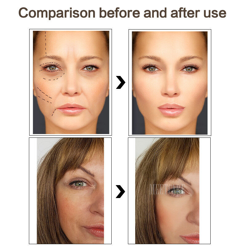 YOOKIILYE Con Lăn Derma Với Chai Kim 192pin Đầu Kim Siêu Nhỏ Hydra Tự Động Máy Dermaroller Kim Siêu Nhỏ Titan 0.25Mm Tiêm Chống Mụn Trứng Cá
