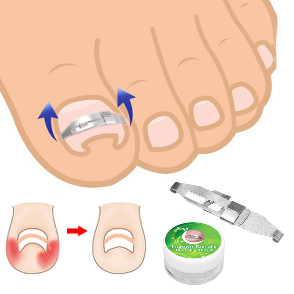 Ingrown Toe Nail Correction Tool Toenail Straightening Correctors Patch