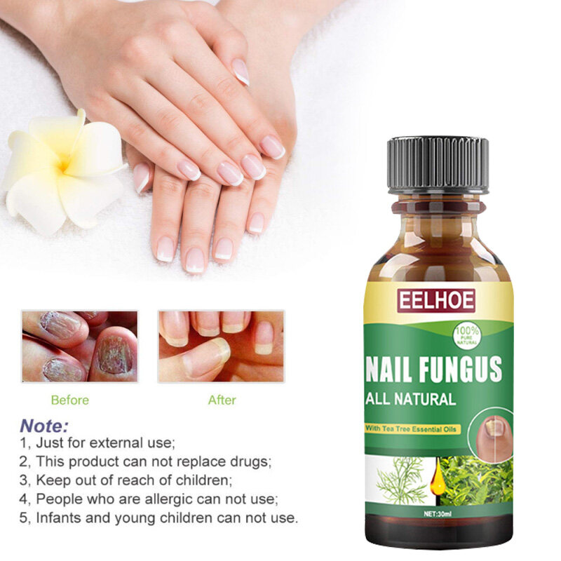 Eelhoe Tea Tree Oil Nail Fungus Treatment Essence Anti Infective Paronychia Onychomycosis Toe Care Repair Serum Foot Nail Fungus Repair Gel Foot Care Solution(30ml) | Lazada PH Eelhoe Tea Tree Oil Nail Fungus Treatment Essence Anti Infective Paronychia Onychomycosis Toe Care Repair Serum Foot Nail Fungus Repair Gel Foot Care Solution(30ml) | Lazada PH
