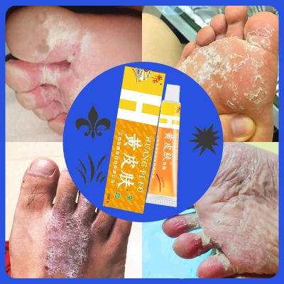 skin ointment antibacterial and antipruritic foot odor itchy feet peeling rotten feet blisters removing calluses moisturizing repairing toe cracks foot care ointment inner thigh scrotum itching beriberi and itching