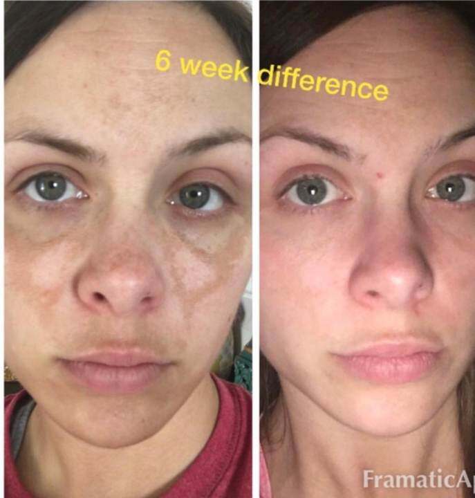 melasma cream hydroquinone