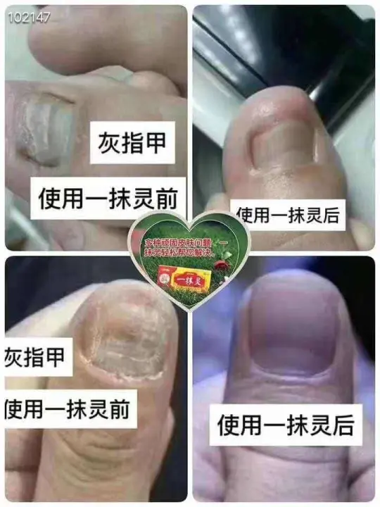 灰指甲克星鸡爪风 甲癣 油灰指甲 甲真菌病remedy For Onychomycosis Ringworm Of The Nails Nail Fungus Lazada 灰指甲克星鸡爪风 甲癣 油灰指甲 甲真菌病remedy For Onychomycosis Ringworm Of The Nails Nail Fungus Lazada