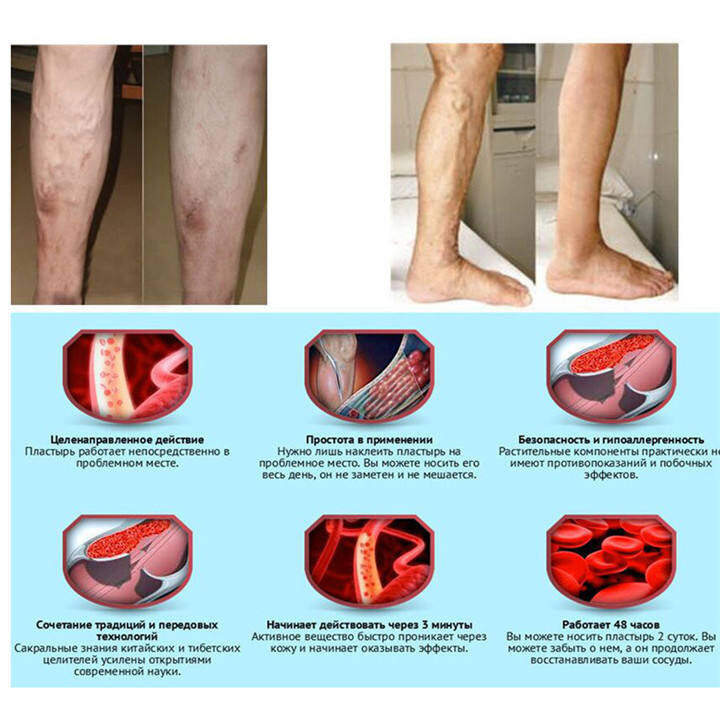 Remedii naturiste în bolile picioarelor dureroase