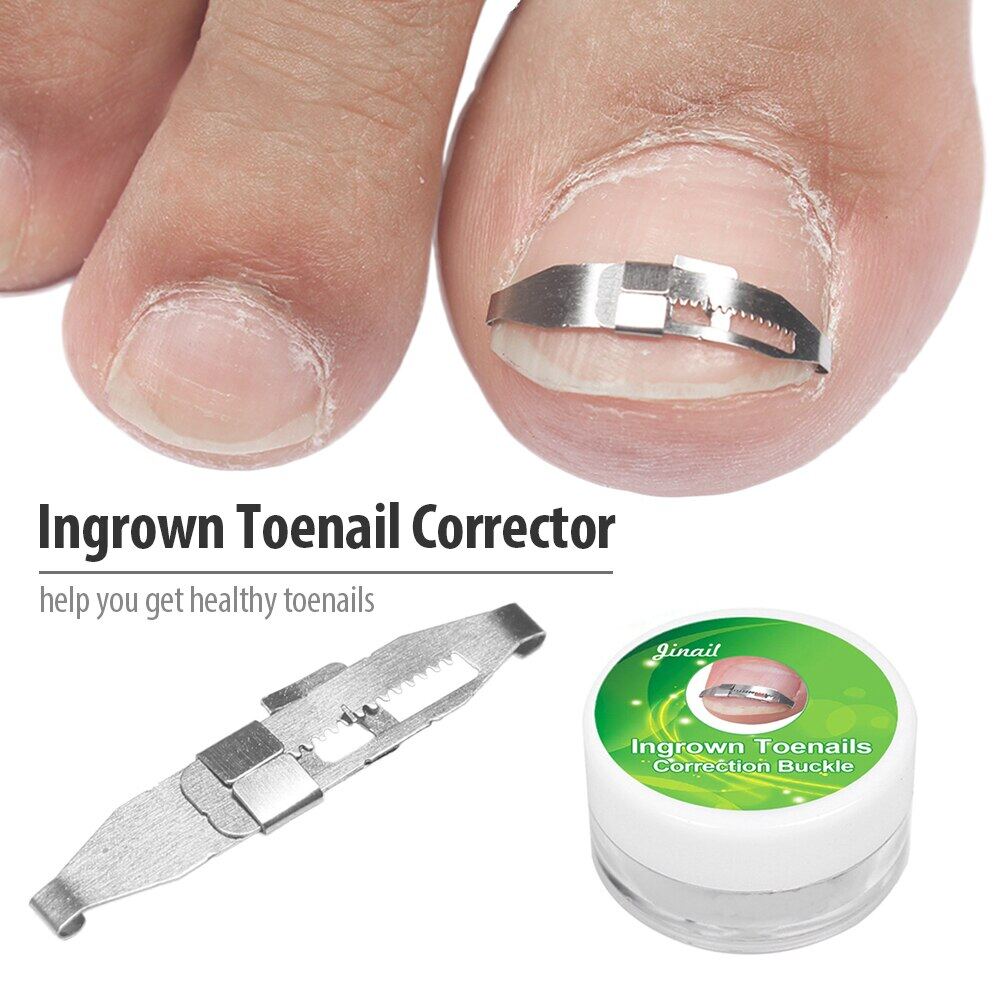 Ingrown Toenail Corrector Toe Nail Correction Treatment Tool Orthotic
