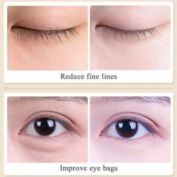eye bags and wrinkles