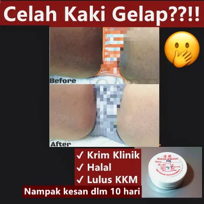 Krim Cerah untuk celah kaki hitam gelap (KLINIK Kulit) celah paha whitening cream clinic body halal