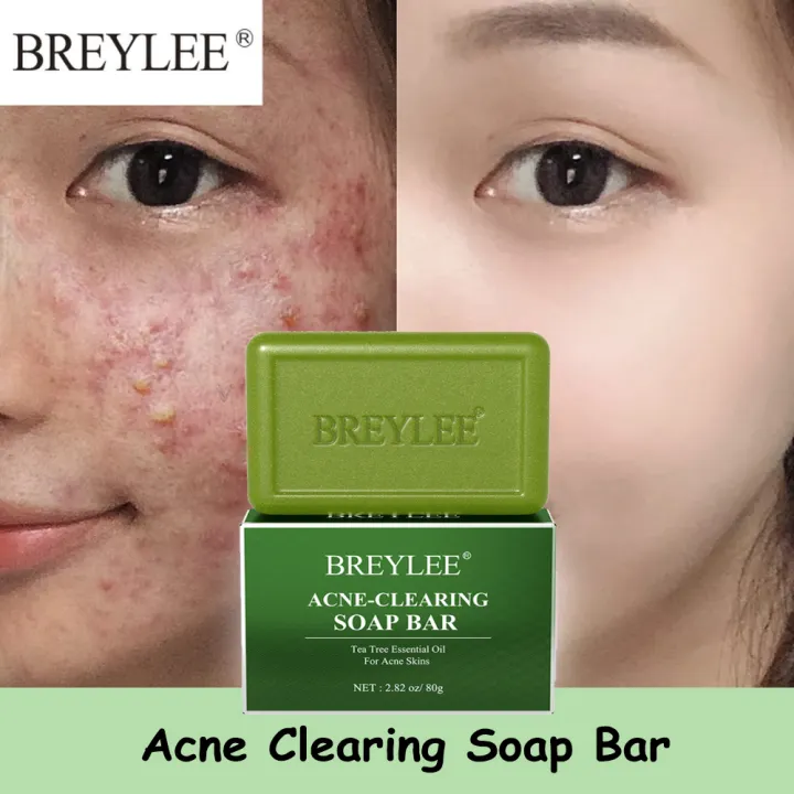 pimple face soap