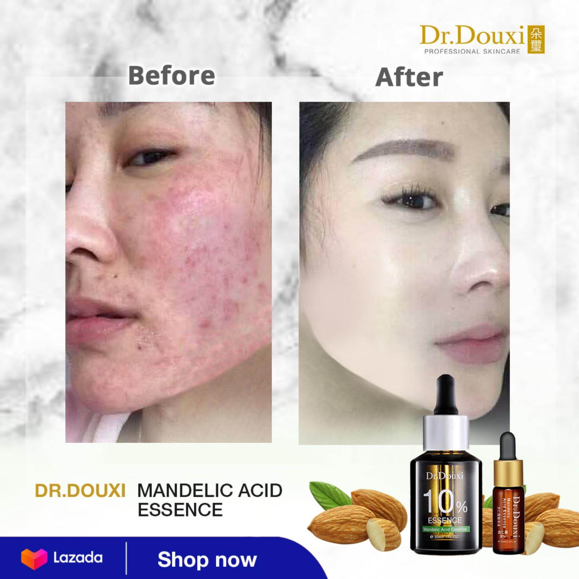 Dr Douxi Mandelic Acid Essence 10 10ml For Skin Repair Pore Control Skin Brightening Acne Treatment Lazada