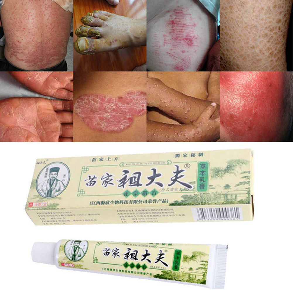 AWEI1 Chinese Medicine Dermatitis Psoriasis Eczema Ointment Allergy Itch Skin Cream