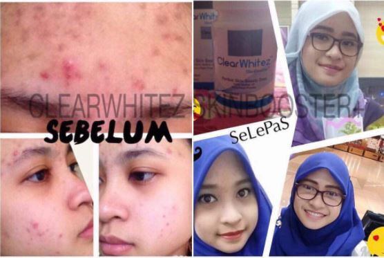 clear whitez skin booster