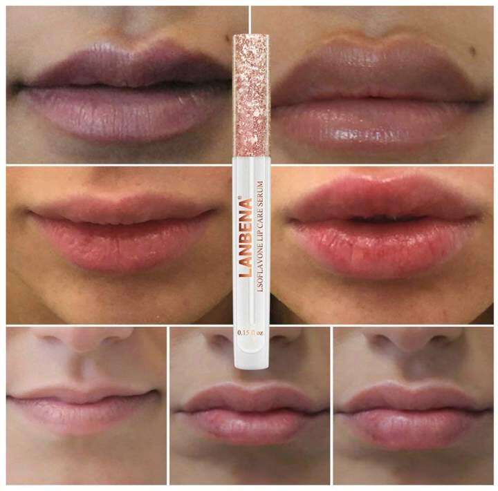 lip wrinkle repair