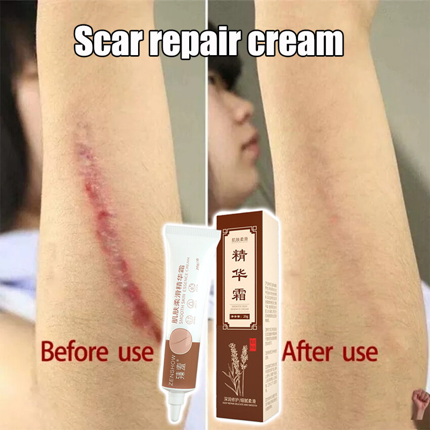 Scar Repair Cream Reduce Scar Area Fade Scar Color Prevent Scar Hyperplasia Smoothing Whitening Moisturizing Hydrating Skin Care 20g