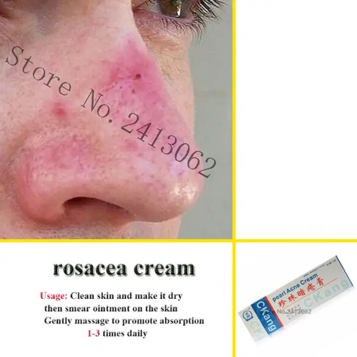 creams to treat rosacea