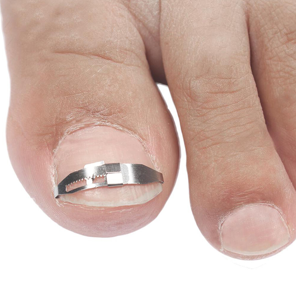 Ingrown Toe Nail Correction Tool Toenail Straightening Correctors Patch Tool